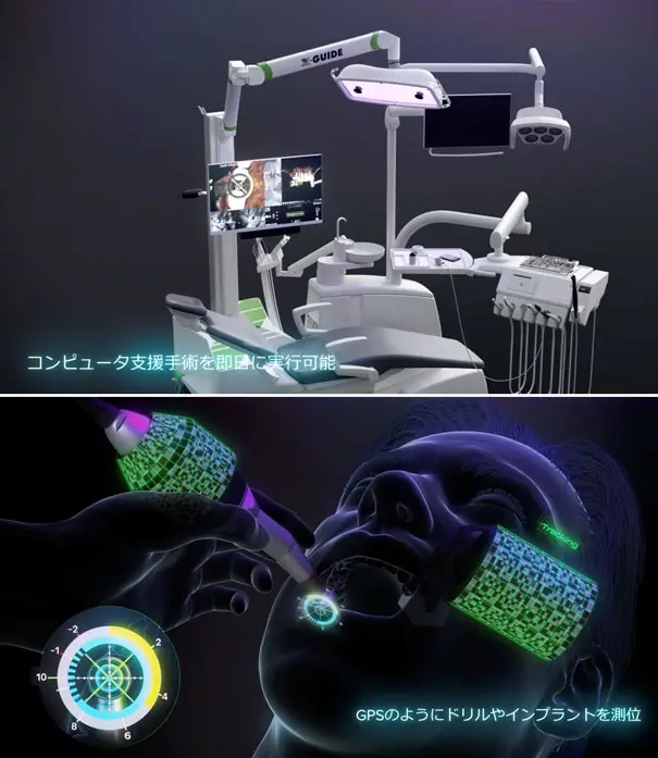 フラップレスインプラント | 三国丘歯科クリニック｜堺市堺区三国ヶ丘
