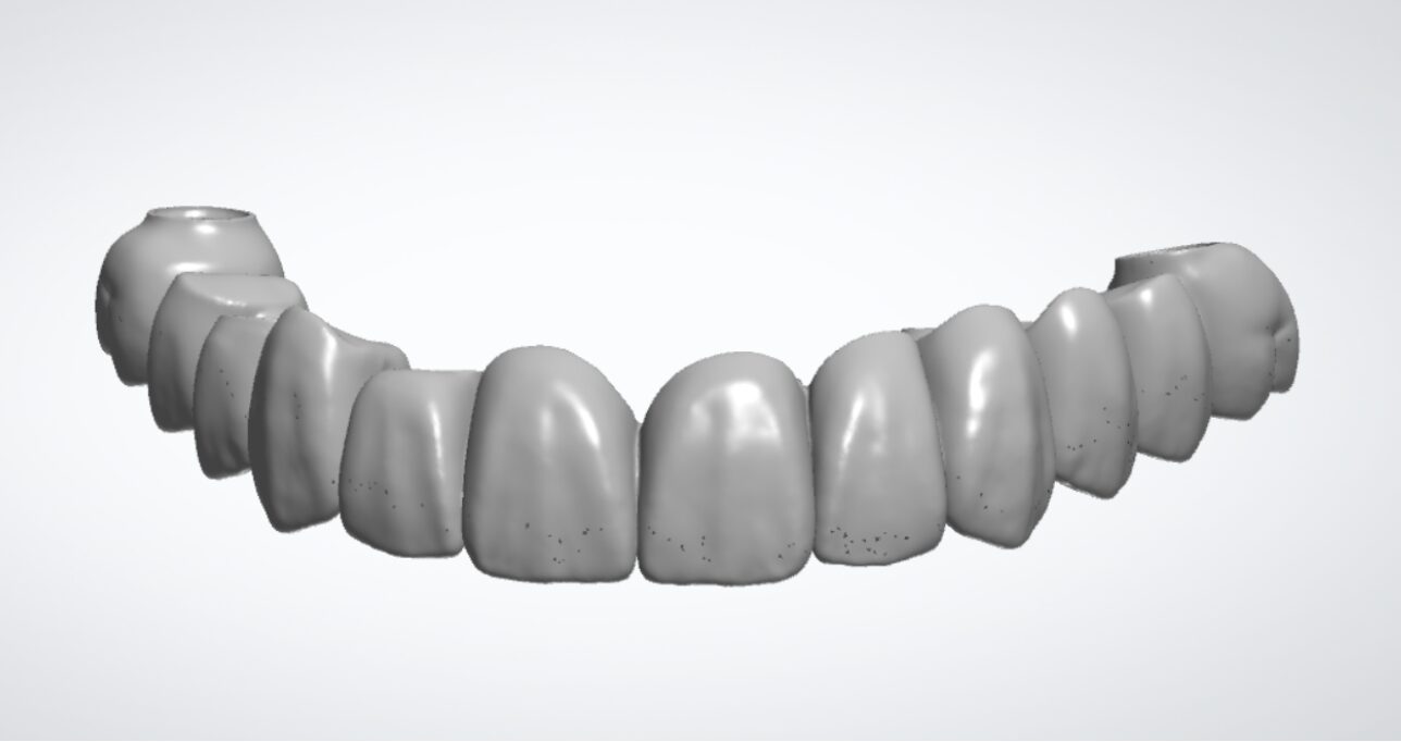 インプラントシミュレーション画像②