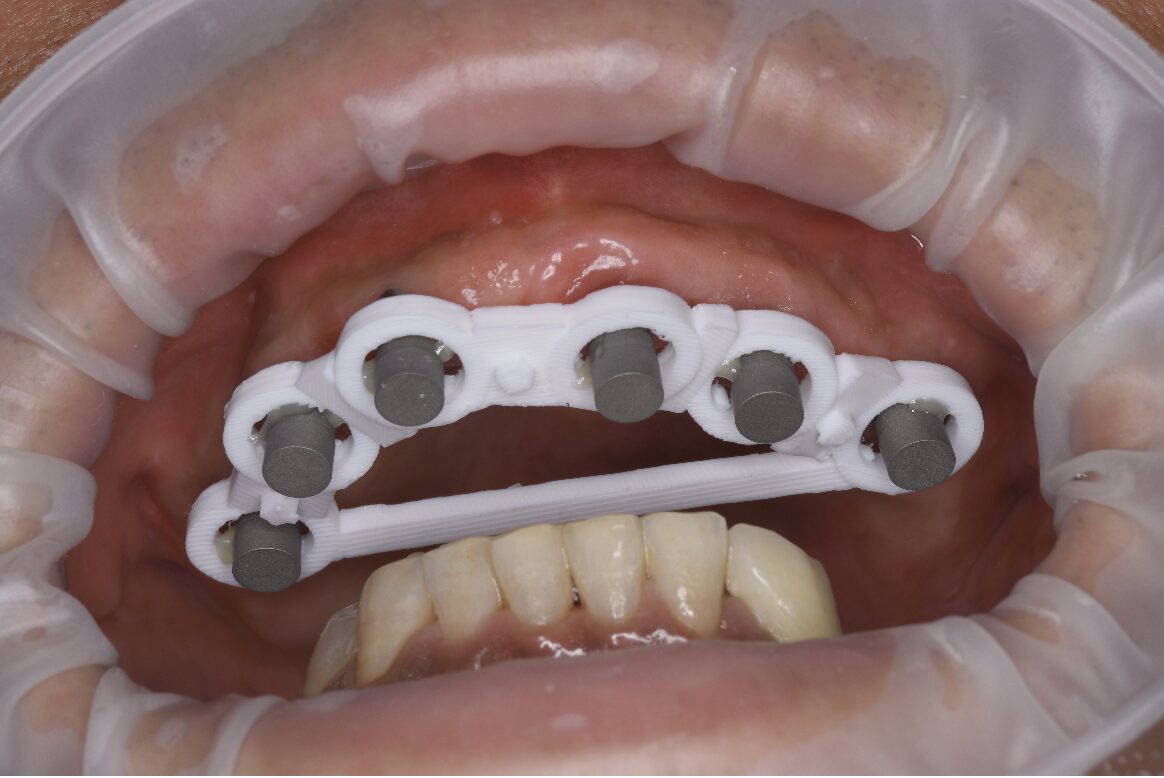 インプラントシミュレーション画像①