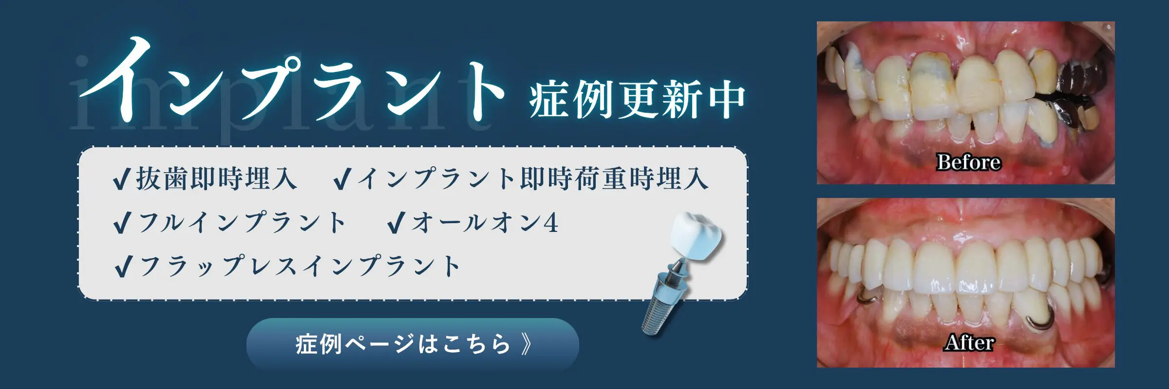 インプラント | 三国丘歯科クリニック｜堺市堺区三国ヶ丘の歯医者