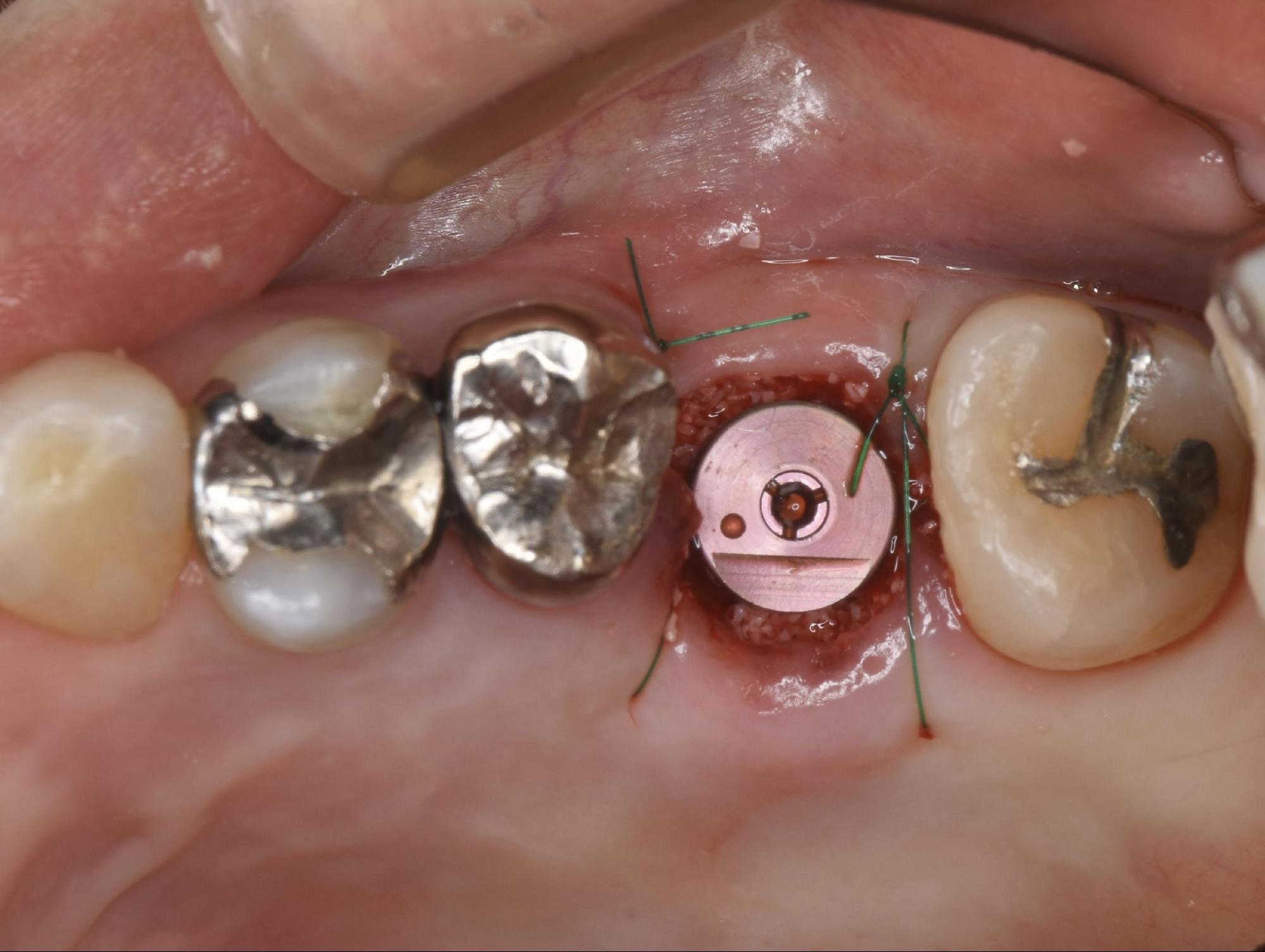 インプラント埋入手術直後