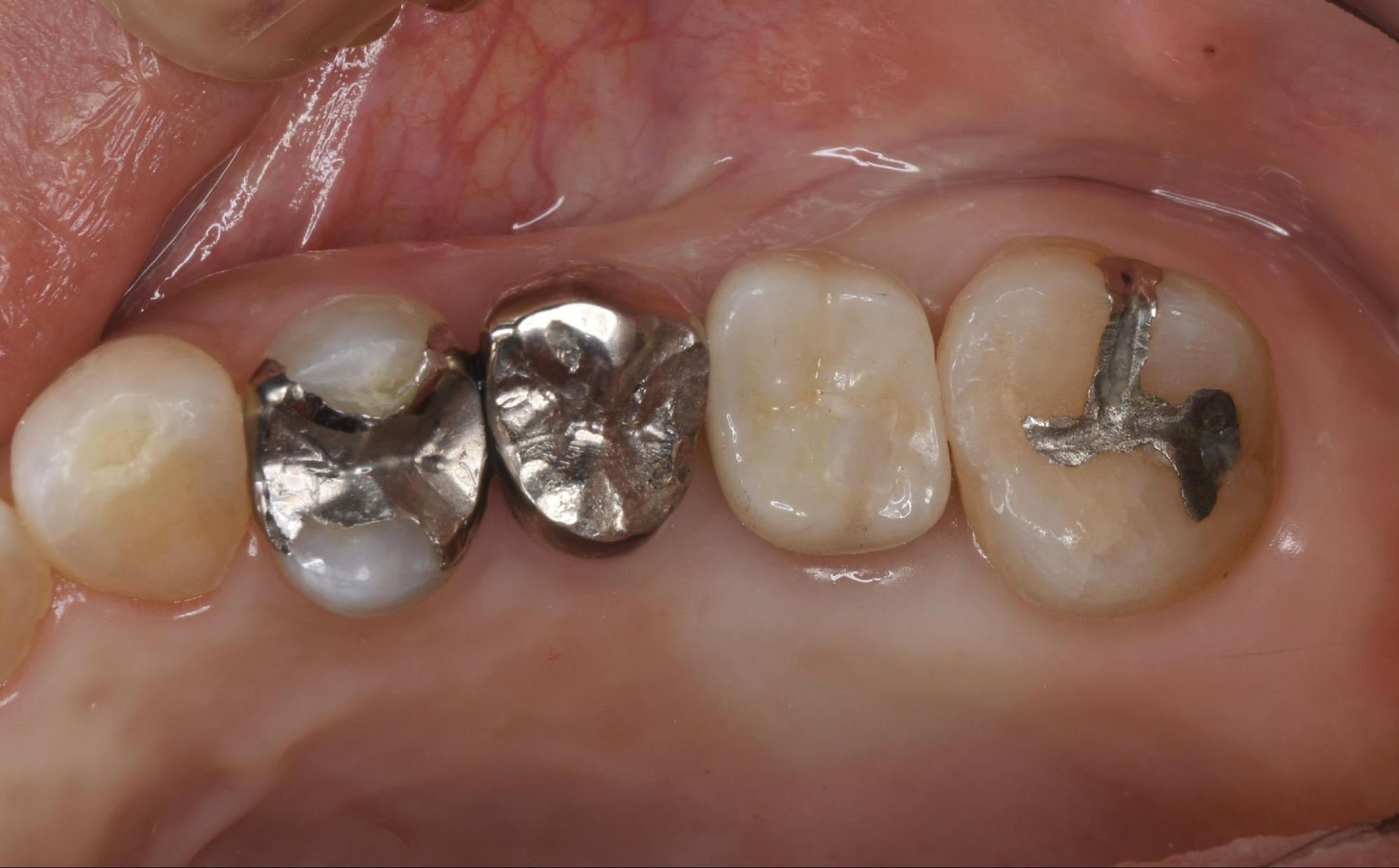 インプラント上部構造写真